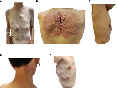 Case report: A case of advanced gastric cancer with multiple skin metastases, with significant relief from immunotherapy